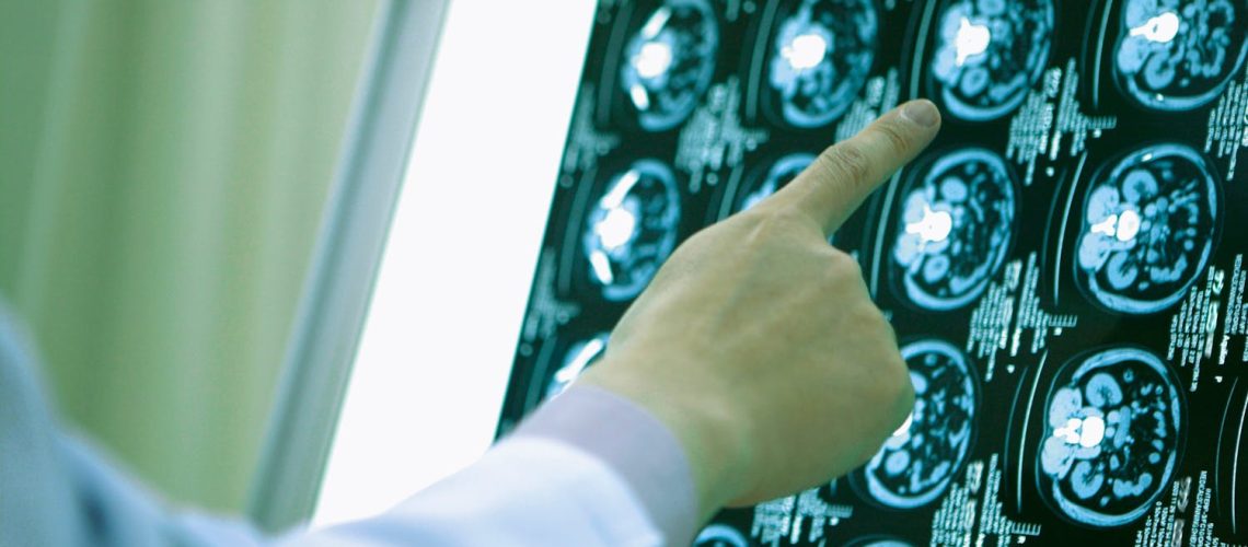 Tout savoir sur l'électroencéphalogramme (EEG)